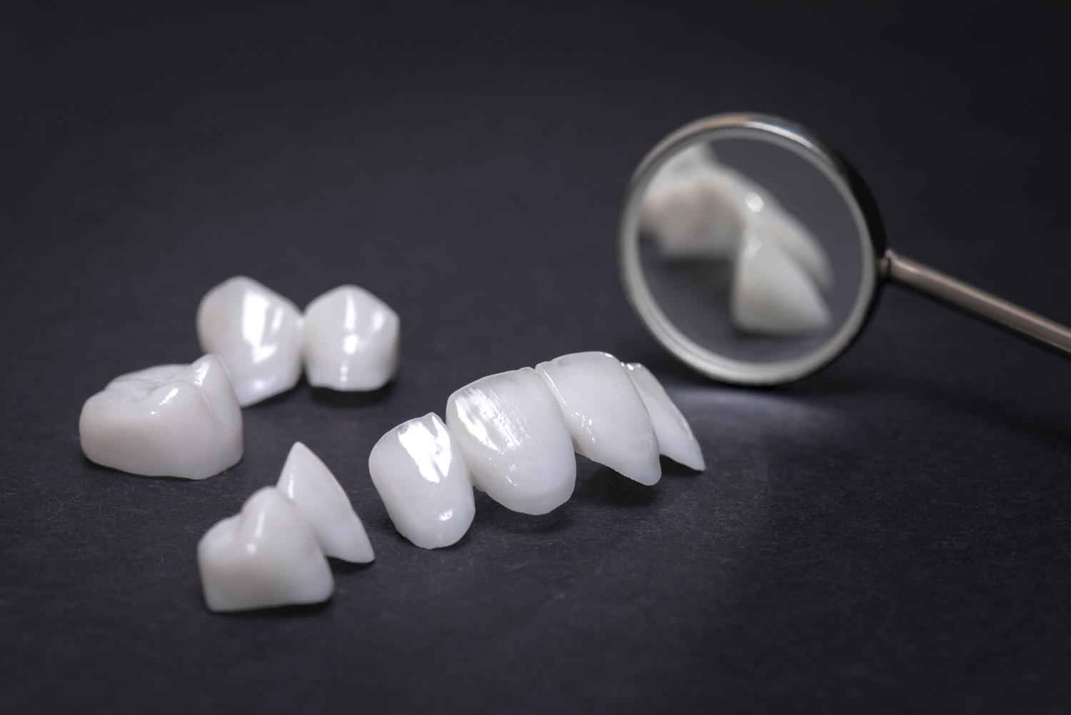 Ceramic veneers