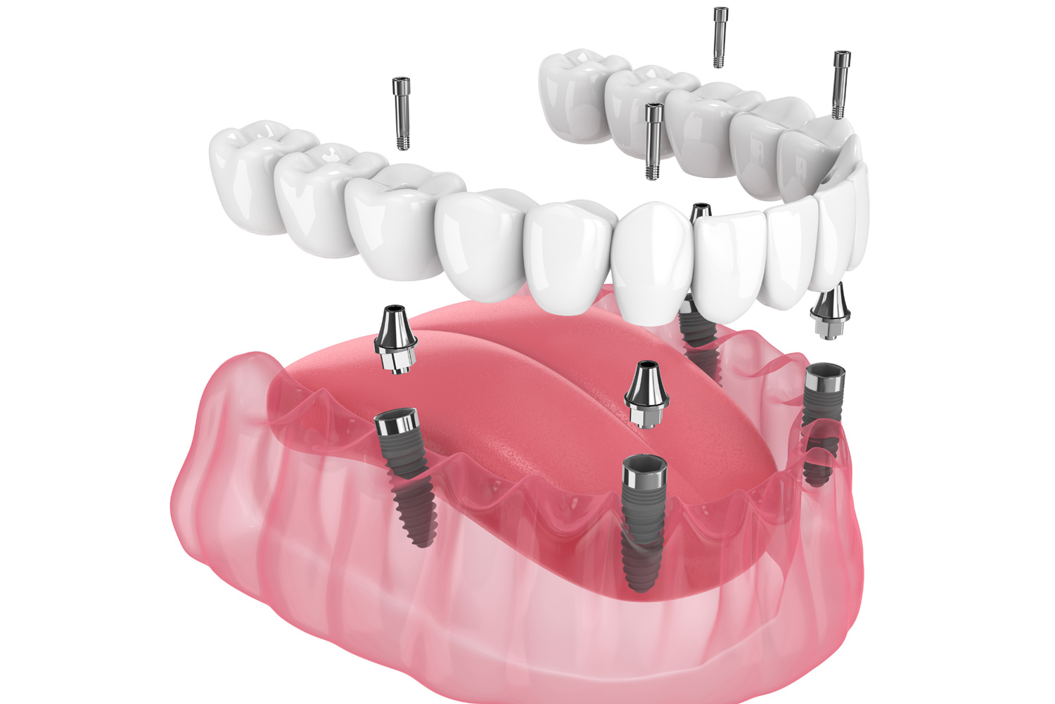 Mandibular prosthesis